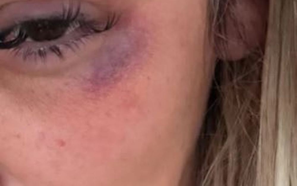 Pjevačica Monika Ivkić u suzama ispričala da ju je nakon nastupa u klubu pretukla gazdarica
