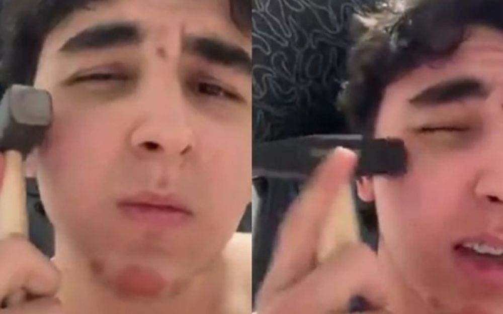 Rusijom se širi "bone smashing": Mladi se udaraju čekićima po licu zbog "muževnijeg" izgleda